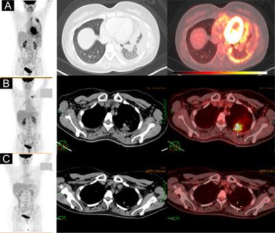 Case report: Osimertinib administration during pregnancy in a woman with advanced EGFR-mutant non-small cell lung cancer